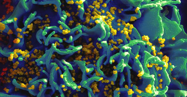 Scanning electron micrograph of HIV particles infecting a human H9 T cell