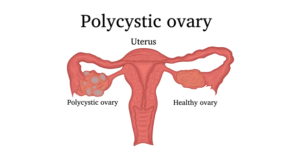 Women’s reproductive organs, with uterus and ovaries labeled. One ovary is deformed by cysts and labeled polycystic ovary; the other is normal and labeled healthy ovary.