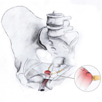 Uterosacral Ligament Suspension