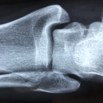 X-ray of human forearm showing elbow, top of radius and ulna