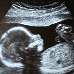 An ultrasound image scan of a human fetus.