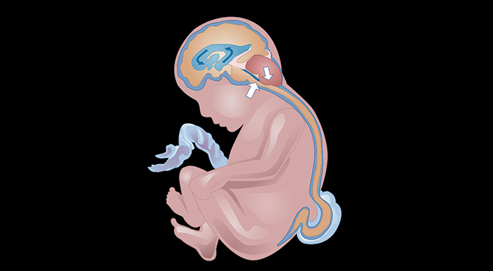 Medical illustration of myelomeningocele repair