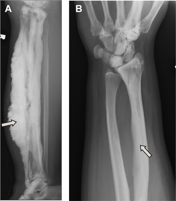 X-ray images of bones with traditional dripping candle wax form of melorheostosis and the form linked to mutations in the SMAD3 gene.