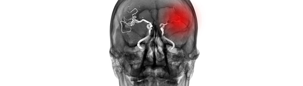 Computerized Tomography scan shows absence of blood flow to left brain. The patient has ischemic stroke or cerebrovascular disease from atherosclerotic stenosis.