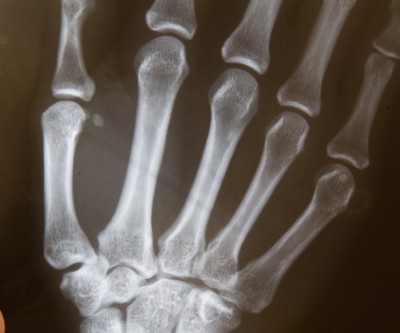 X-rays of hand and wrist bones are held against a light box.