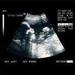 An ultrasound image of a fetus.