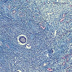 Fibroids in uterine muscle tissue.