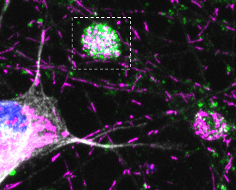 Purple mitochondria and green autophagosomes appear as lines and blotches against a black background. A large purple, green, and white ball representing swelling in the axon appears in the center and is outlined by a white dashed line. The neuron cell body is visible in the lower left.