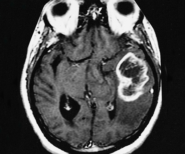 Greyscale image of a brain with a tumor exhibiting a 'ring-like' zone of contrast enhancement around a dark central area.