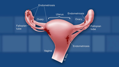 The female reproductive organs are shown with red patches of endometriosis located on the ovaries and on the outside of the uterus. The uterus, fallopian tubes, ovaries, vagina, and areas of endometriosis are labeled.