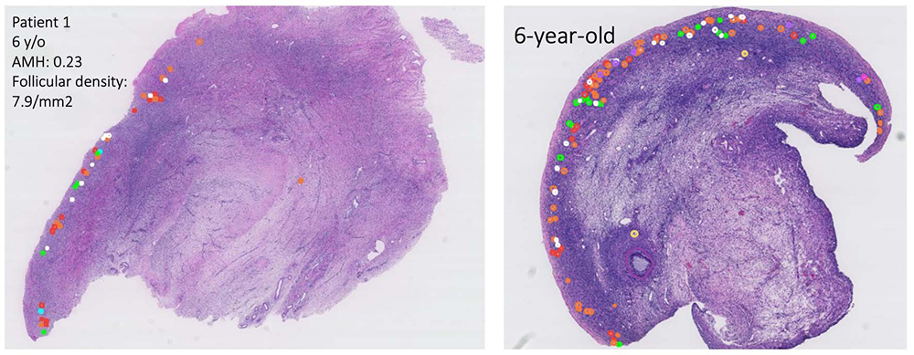 Left panel shows a purple-stained tissue sample with several small, multi-colored dots on the periphery. Right panel shows a purple-stained tissue sample with a high concentration of multi-colored dots on the periphery.