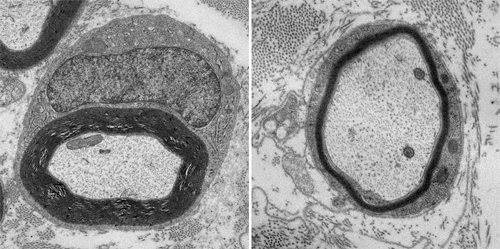 Sciatic nerves from normal mice (left) and mice lacking PIK4A (right). Loss of PIK4A leads to abnormal nerves that lack sufficient myelin. Credit: NICHD/NIH