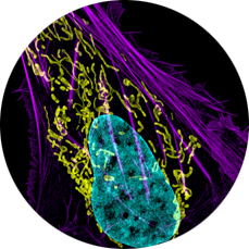 Microscopic view of bone cancer cell