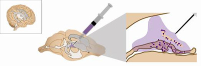 Ventricles in a brain