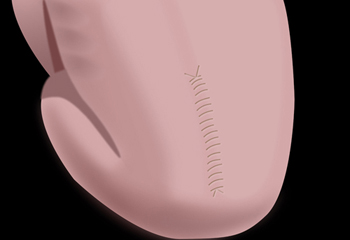 a diagram of the surgery to repair myelomeningocele.