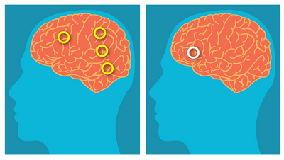 Image of brain activity during rhyming tasks in typical and dyslexic brains.