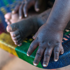 small child with polydactyly